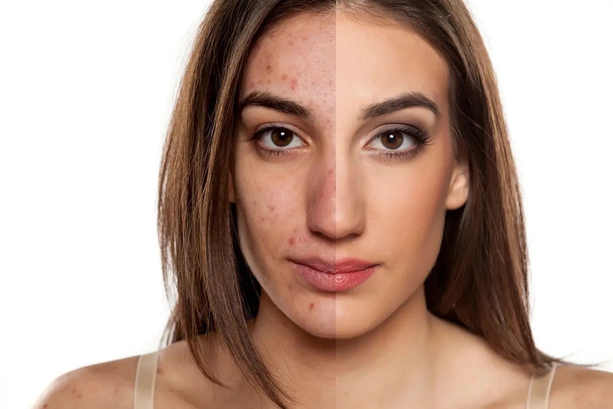 What Causes Acne?