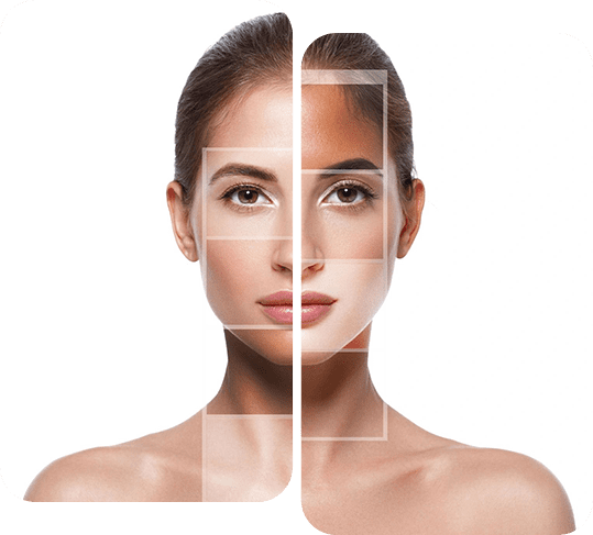 We also treat acne scarring