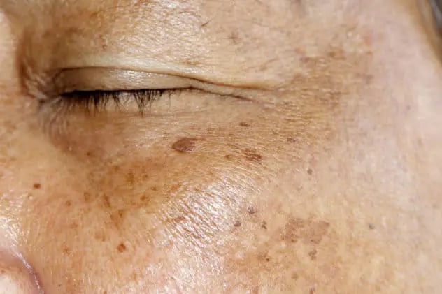 hyperpigmentation-treatment-in-houston