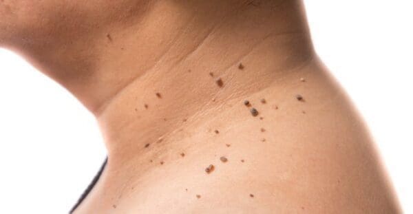 skin-tag-removal-in-houston-tx