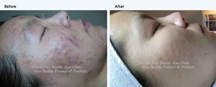 hyperpigmentation